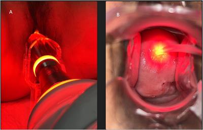 The efficacy and safety of local 5-aminolevulinic acid-based photodynamic therapy in the treatment of cervical high-grade squamous intraepithelial lesion: a single center retrospective observational study